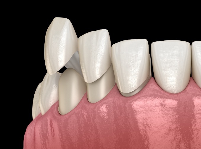 Animated smile during metal free dental restoration placement
