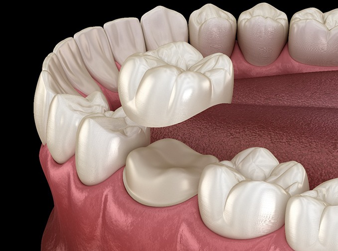 A 3D illustration of placed dental crowns in Inver Grove Heights
