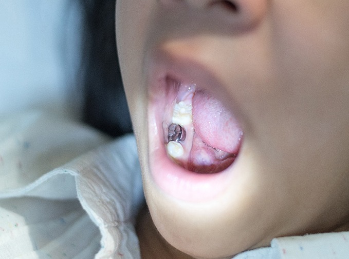 Child with a silver dental crown