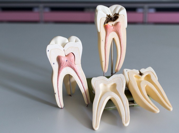 Model teeth used to explain tooth extractions