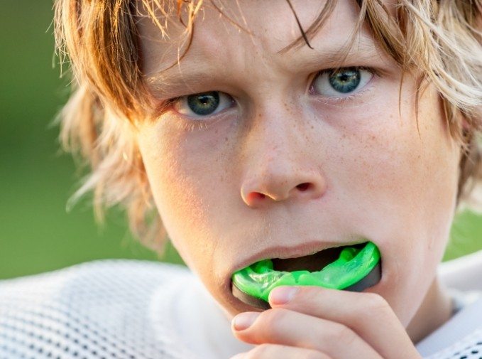 Teen placing a custom mouthguard