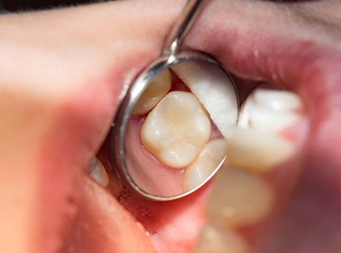 Dental mirror showing tooth-colored filling in patient’s mouth