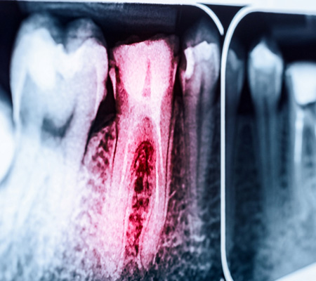 An X-ray image of an infected tooth