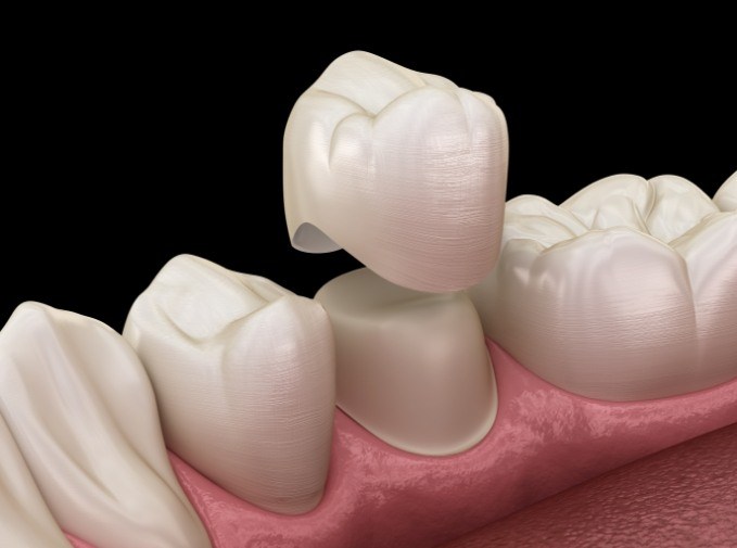 Animated smile during metal free dental crown placement