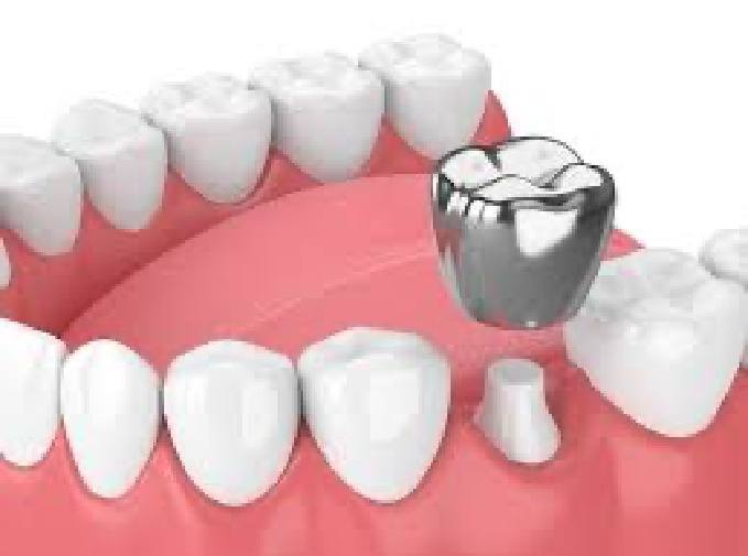 Animated smile during stainless steel dental crown placement
